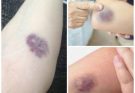 NEWS Understanding Bruises: Causes, Types, and Effective Treatments